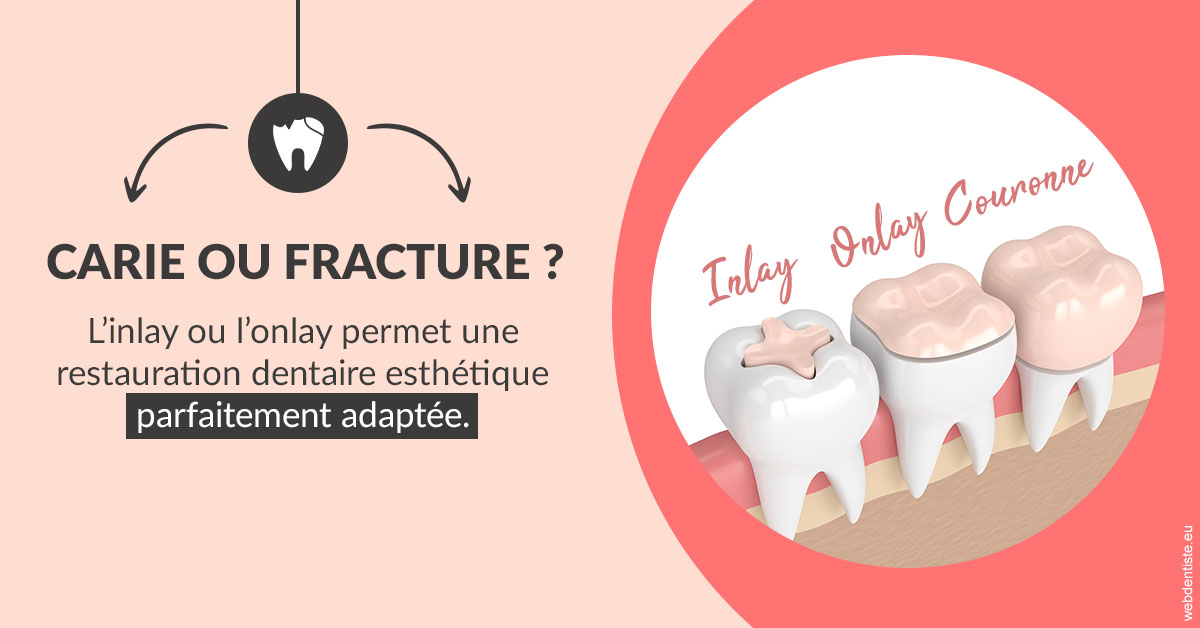 https://dr-dossou-olga.chirurgiens-dentistes.fr/T2 2023 - Carie ou fracture 2