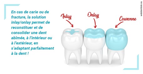 https://dr-dossou-olga.chirurgiens-dentistes.fr/L'INLAY ou l'ONLAY